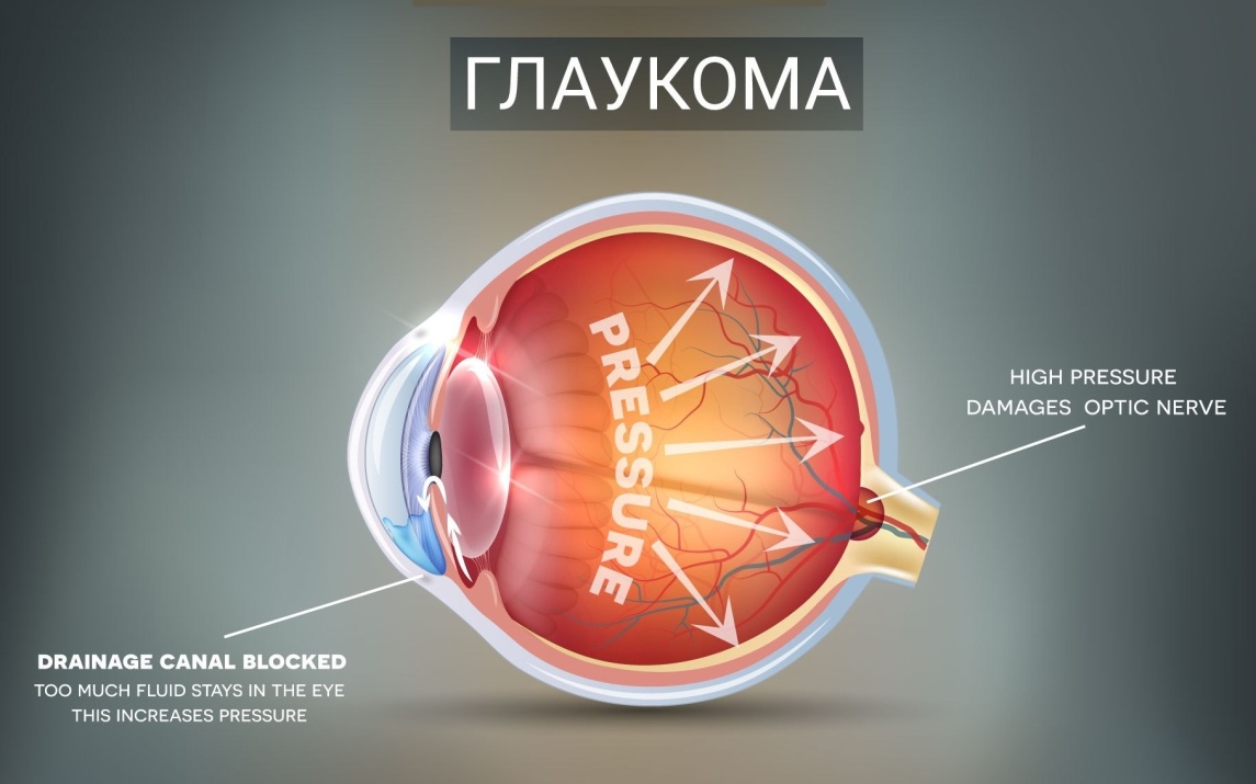 ГЛАУКОМА: ПРИЧИНИ РОЗВИТКУ ТА РЕКОМЕНДАЦІЇ | Вінницька міська клінічна ...